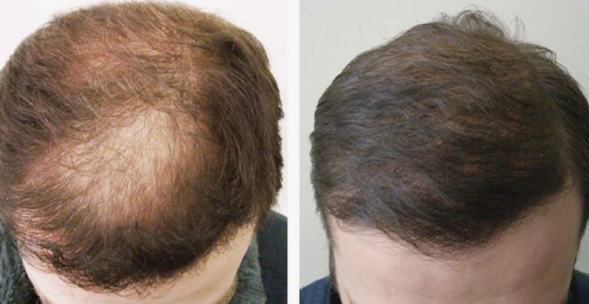 Before &After